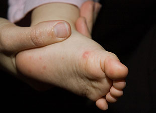 World First Hand' Foot And Mouth Vaccine Developed