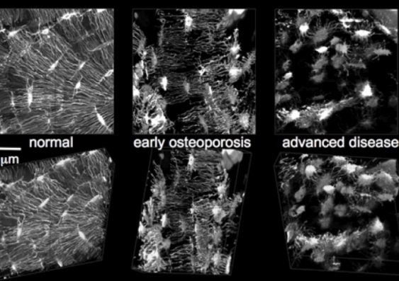 The imaging technique showing early and advanced osteoporosis. Credit: UNSW.