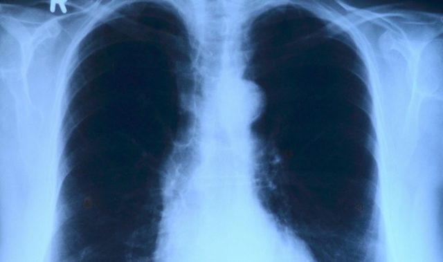 There Are Way More TB Cases In India Than Estimated: Study