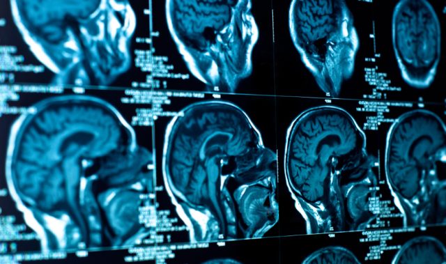 Bassoon Gene Linked To Rare Brain Disorder