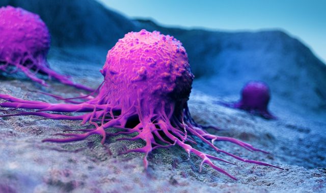 Spotting Cancer Cells In Lymph Nodes