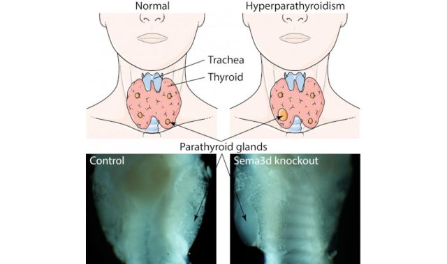 Suppressing Parathyroid Gland Overactivity
