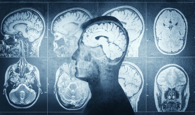 New Non-Invasive Brain Surgery Can Help Treat OCD