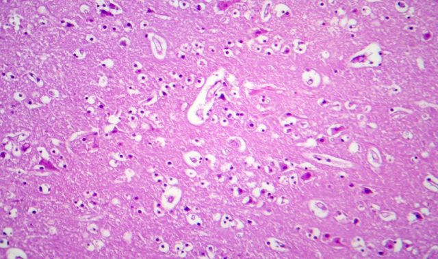 Declining Japanese Encephalitis Immunity Tied to Intensified Dengue