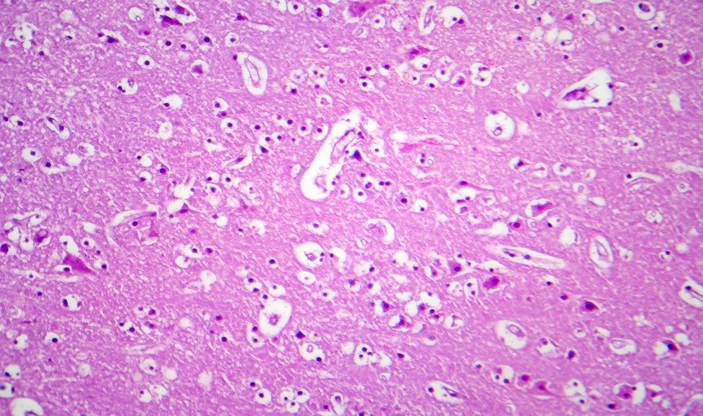 Imunitas Menurun terhadap Japanese Encephalitis Bisa Perparah Penyakit Dengue